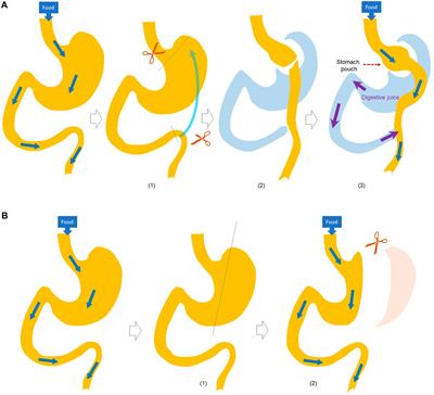 Effects of bariatric surgery on drug pharmacokinetics—Preclinical studies